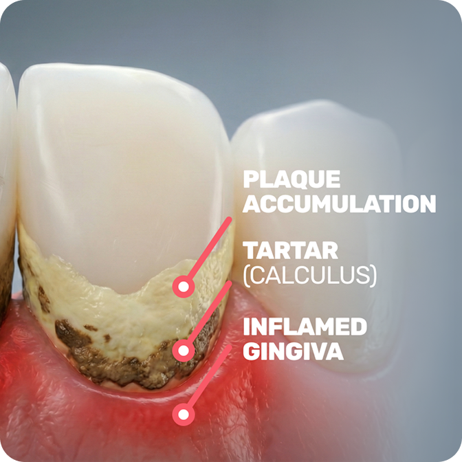 The gumline is often neglected