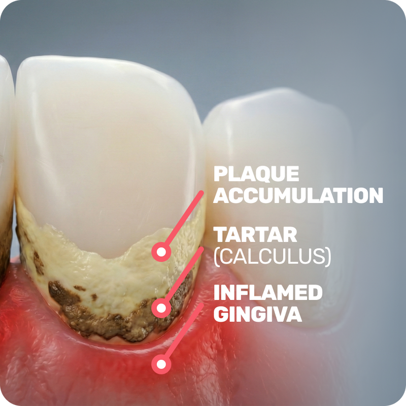 Plaque between teeth fuels hidden inflammation