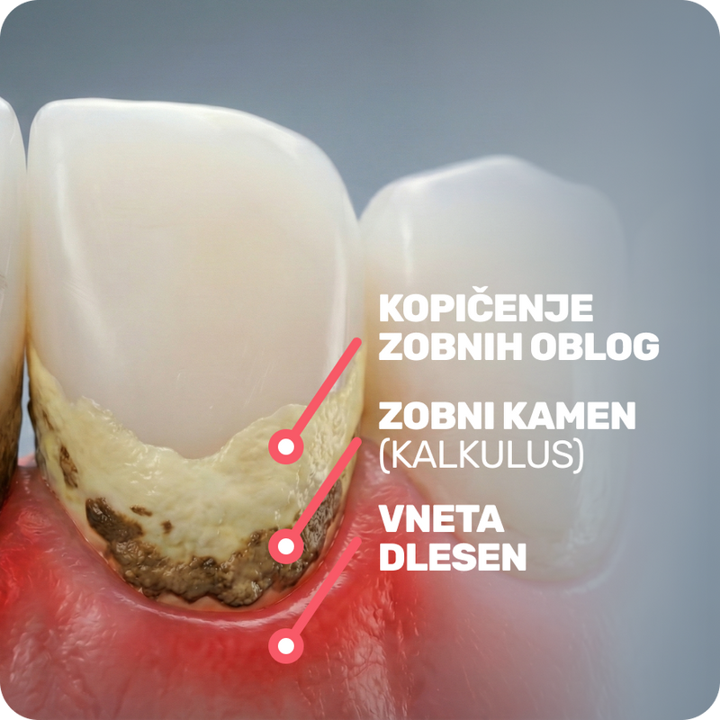 Zobne obloge med zobmi spodbujajo skrito vnetje