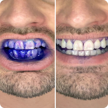 Najbolji eliminator zubnih naslaga