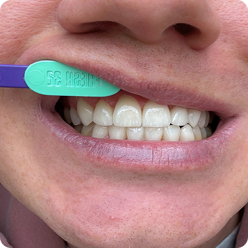 Osjetljiva zubna caklina